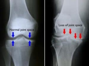 X-ray bone-on-bone vs normal knee
